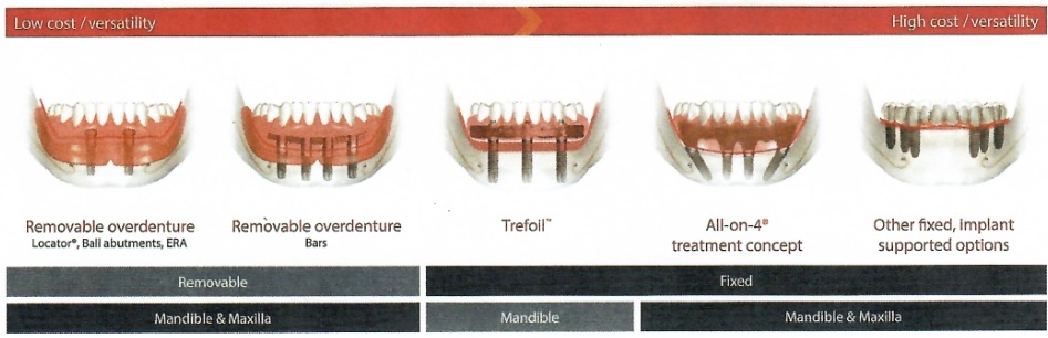 dental implant options