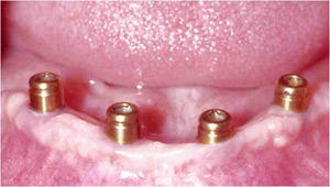 dental implant posts