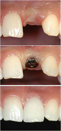 missing tooth needing dental implant