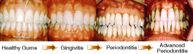 Gum Disease Diagnosis